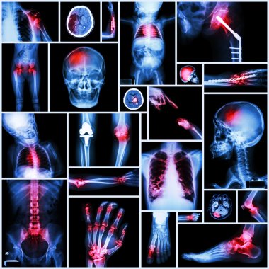 Collection of X-ray multiple part of human,Orthopedic operation and multiple disease (Shoulder dislocation,Stroke,Fracture,Gout,Rheumatoid arthritis,Bronchiectasis,Osteoarthritis knee, etc ) clipart