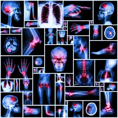 Koleksiyon X-ray birden fazla organ ve birden çok ortak (Romatoid, gut hastalığı, artrit)