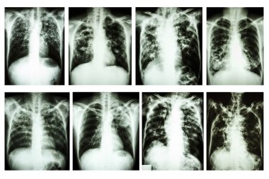 Collection of chest x-ray 