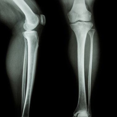 Film x-ışını bacak ve diz Ap(Anterior-Posterior), lateral