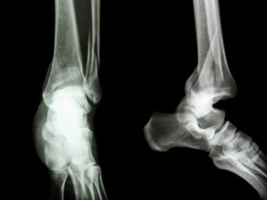 Distal tibia ve fibula kırığı