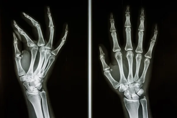 Huesos de manos humanas — Foto de Stock
