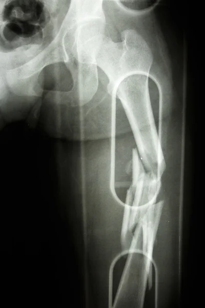 Fracture shaft of femur — Stock Photo, Image