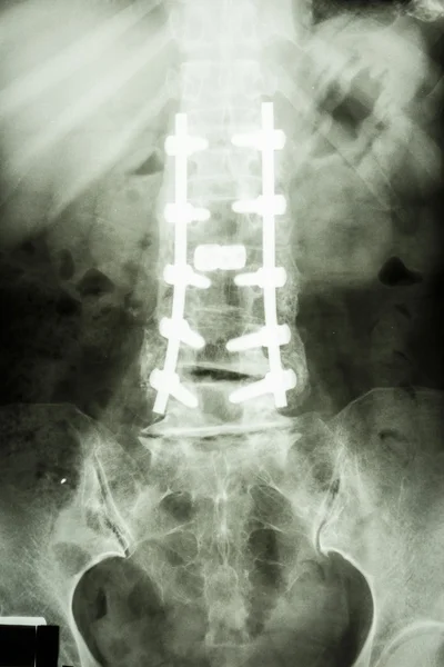 Coluna lombar com fixação do parafuso pedículo — Fotografia de Stock