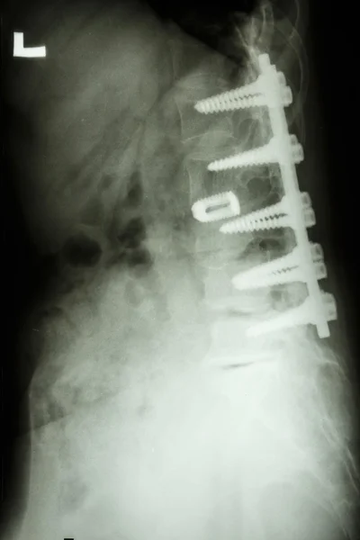 Coluna lombar com fixação do parafuso pedículo — Fotografia de Stock