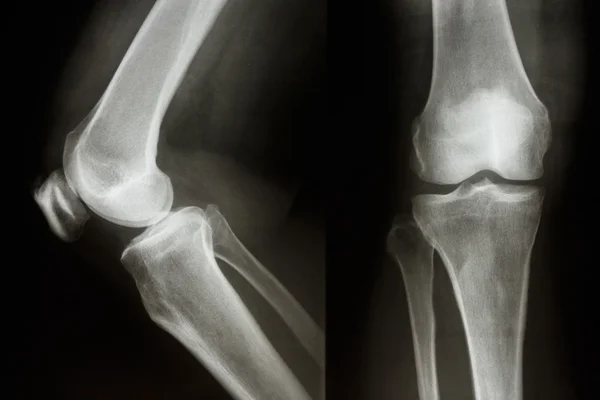 Normal knee joint — Stock Photo, Image