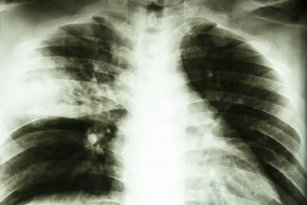 Лобарная пневмония — стоковое фото