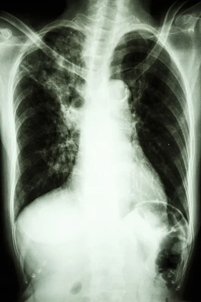 Tuberculosis pulmonar — Foto de Stock