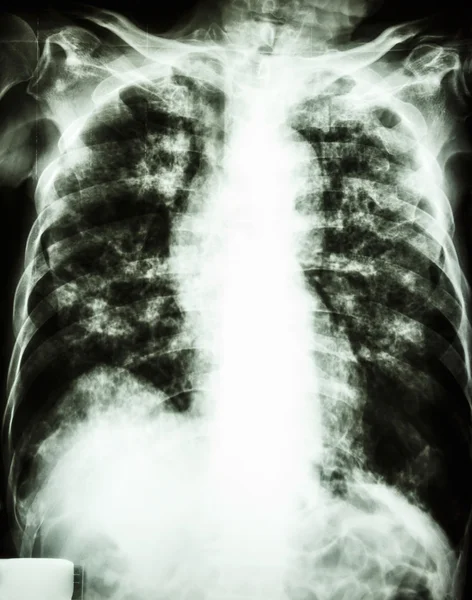 Pulmonary Tuberculosis — Stock Photo, Image