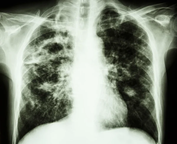 Pulmonary Tuberculosis — Stock Photo, Image