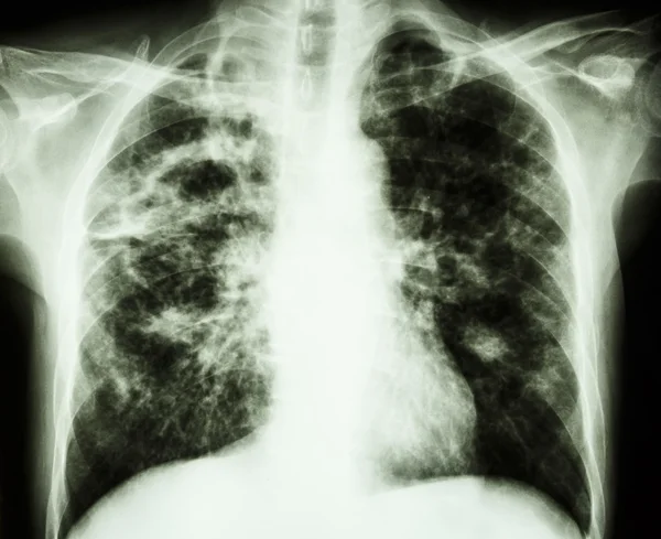 Tuberculose pulmonar — Fotografia de Stock