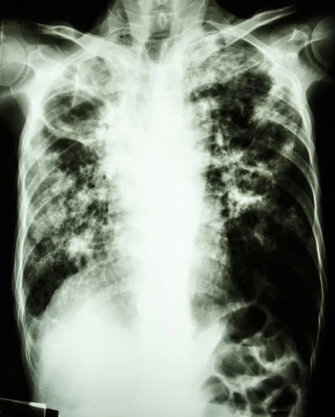 Tuberculose pulmonar — Fotografia de Stock