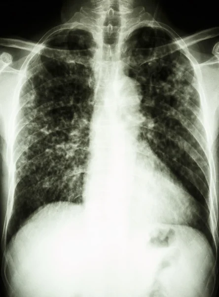 Легочный туберкулёз — стоковое фото