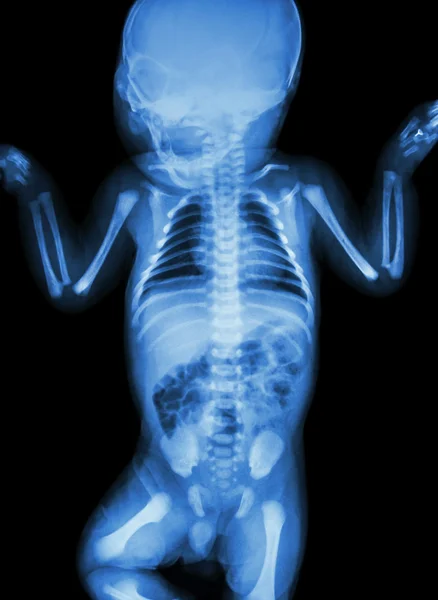 Filme raio-x corpo inteiro do bebê — Fotografia de Stock