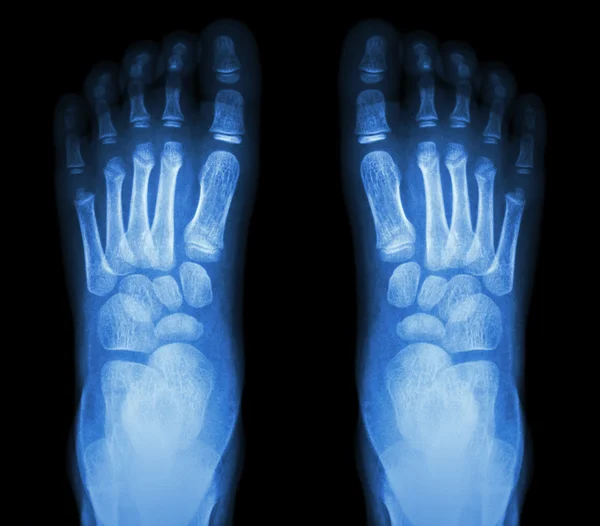 X-ışını normal çocuğun ayağı — Stok fotoğraf