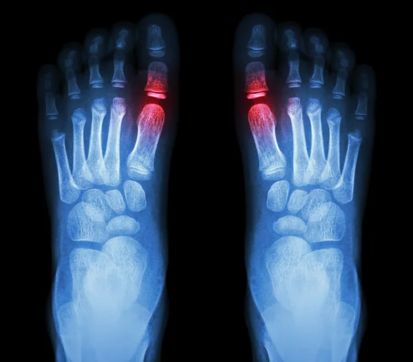 "Rheumatoid arthritis , Gouty arthritis"  X-ray child's foots and arthritis at metatarsophalangeal joint (Big toe area) — Stock Photo, Image