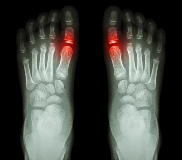 "Rheumatoid arthritis , Gouty arthritis"  X-ray child's foots and arthritis at metatarsophalangeal joint (Big toe area) — Stock Photo, Image