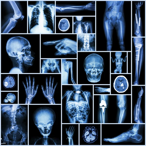 Sammlung Röntgen "multipler Teil menschlicher, orthopädischer Chirurgie und multipler Krankheit" (Fraktur, Lungenentzündung) — Stockfoto