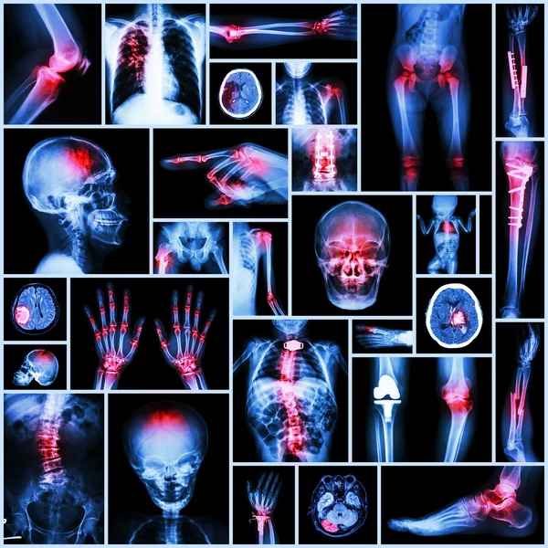 Collection X-ray partie de l'humain, opération orthopédique, maladie multiple (fracture, goutte, polyarthrite rhumatoïde, arthrose du genou, AVC, tumeur cérébrale, scoliose, tuberculose, etc. .) — Photo