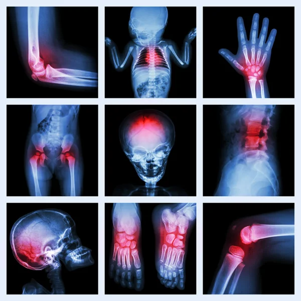 Collection X-ray part of child and multiple injury — Stock Photo, Image