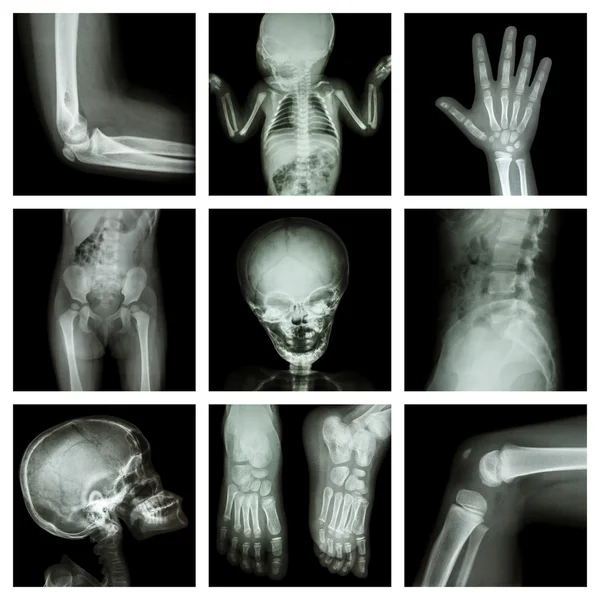 Collection X-ray part of child — Stock Photo, Image