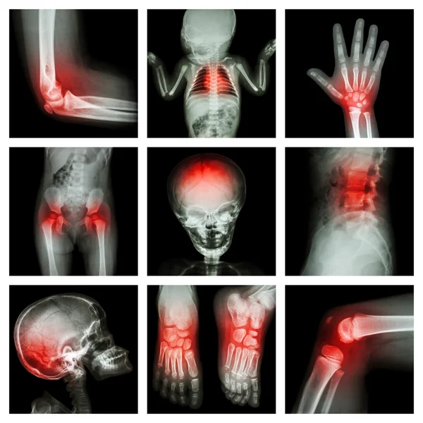 集合 x 射线部分，孩子和多发伤 — 图库照片