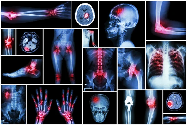 Kolekce rentgen více nemocí (artritida, mrtvice, nádor mozku, DNA, revmatoidní, ledvinový kámen, plicní tuberkulózy, osteoartrózy kolena) — Stock fotografie