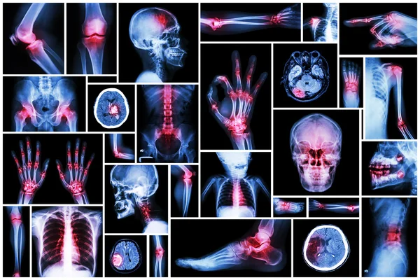 Raio-X de várias partes do ser humano com doença múltipla (acidente vascular cerebral, artrite, gota, reumatóide, tumor cerebral, osteoartrite, etc. ) — Fotografia de Stock