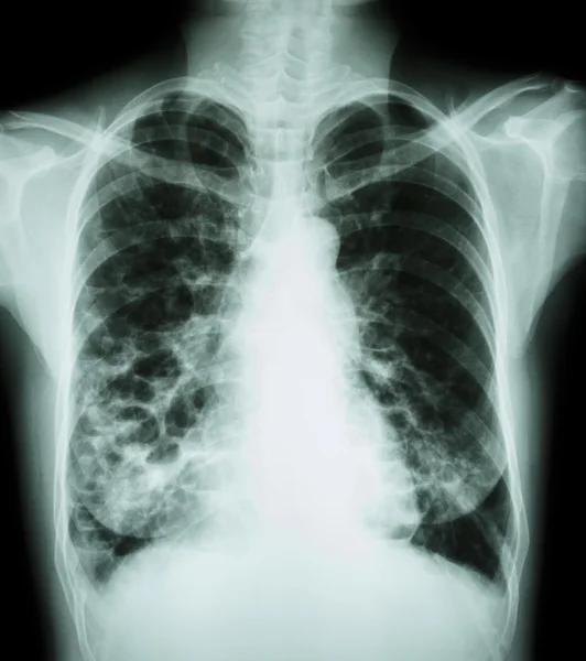 気管支拡張症 — ストック写真