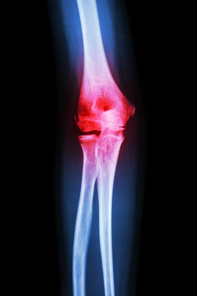 X-Ray mens elleboog en (jicht, reumatoïde artritis) — Stockfoto