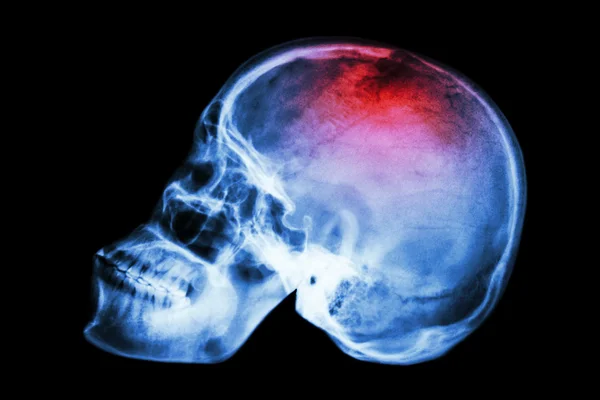 X-ray skull lateral with "Stroke" — Stock Photo, Image