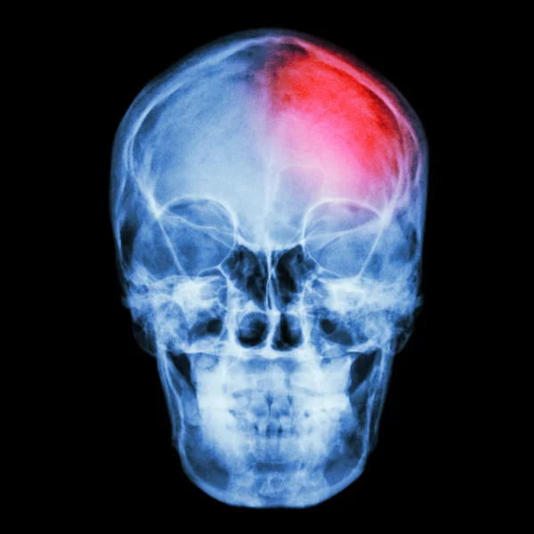 Film X-ray skull and headache. (Stroke,Cerebrovascular accident) — Stock Photo, Image