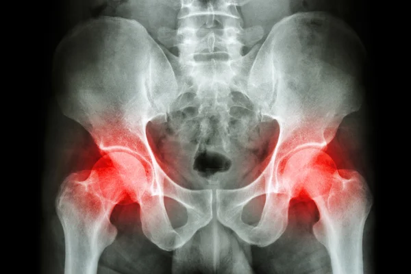 Film x-ray human's pelvis and arthritis at both hip joint (Gout , Rheumatoid) — Stock Photo, Image