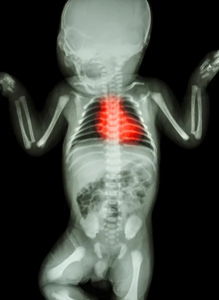 Cuerpo del infante de rayos X con enfermedad cardíaca — Foto de Stock