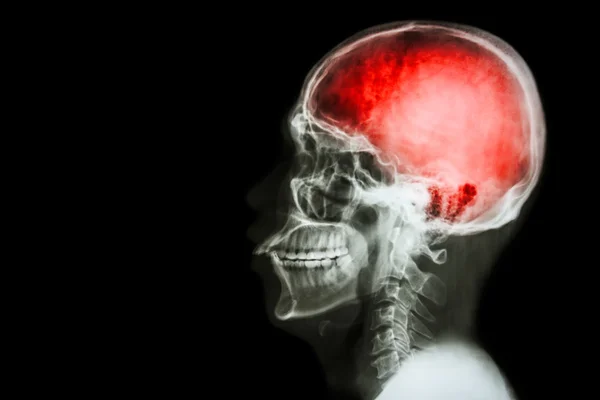 X-ray skull & cervical spine (lateral) with \