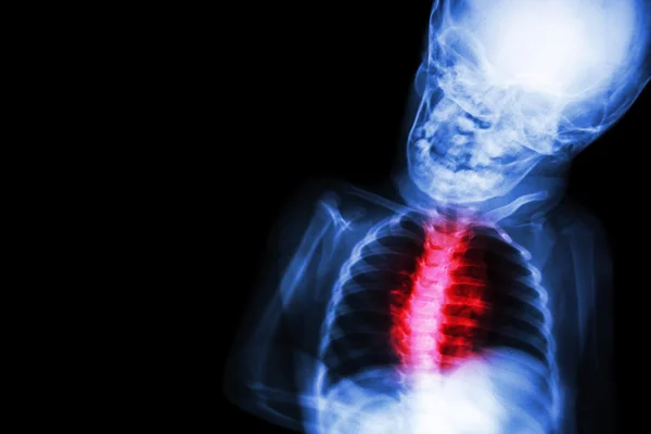 Рентгенівське дитяче тіло з "Вродженою хворобою серця " — стокове фото