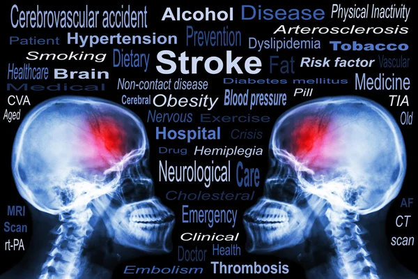 Cráneo de rayos X con "accidente cerebrovascular" y texto médico — Foto de Stock