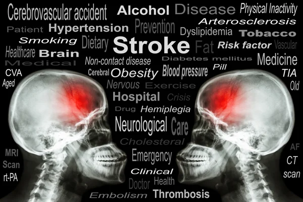 Röntga skallen med "Stroke" och medicinsk text — Stockfoto