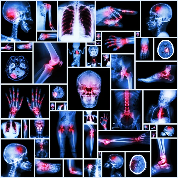 Sammlung Röntgen mehrerer Organe und Arthritis an mehreren Gelenken (Rheumatoide, Gicht)) — Stockfoto