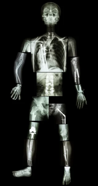 Esqueleto de fractura humana e múltipla. foi operado e fixado internamente por placa e parafuso em múltiplos locais — Fotografia de Stock