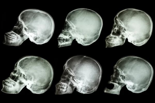 Collection of x-ray asian's skull — Stock Photo, Image