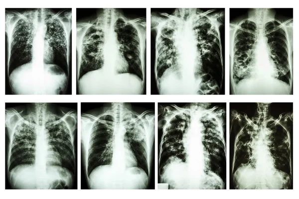 Collection of chest x-ray "Pulmonary tuberculosis" — Stock Photo, Image