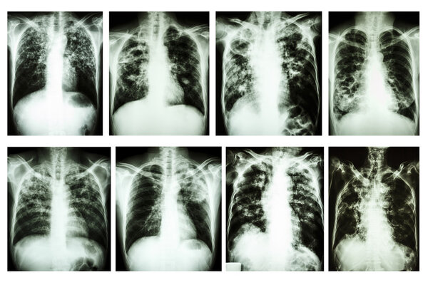 Collection of chest x-ray "Pulmonary tuberculosis"
