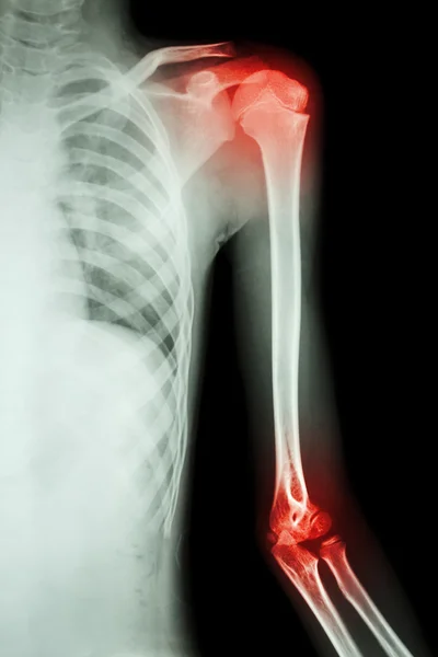 Film x-ray left shoulder — Stock Photo, Image