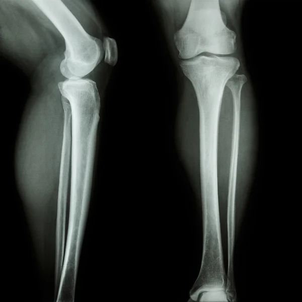 Film x-ray leg & knee AP(Anterior-Posterior) , lateral — Stock Photo, Image