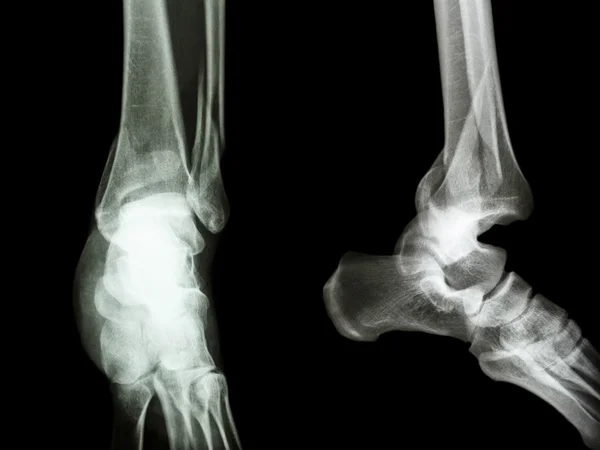 Distal tibia ve fibula kırığı — Stok fotoğraf