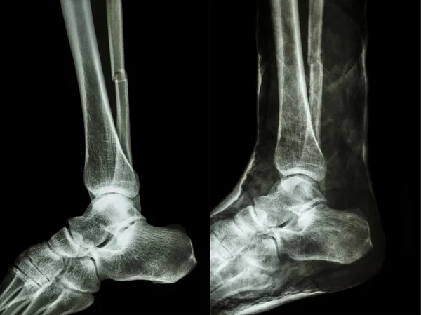 Eje de fractura de rayos X de película de fibular (hueso de la pierna) con yeso (imagen derecha ) — Foto de Stock