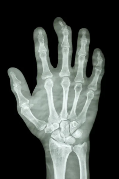 Comminute fracture distal pharange of middle finger — Stock Photo, Image