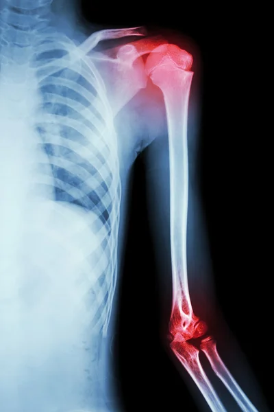 Film x-ray left shoulder — Stock Photo, Image