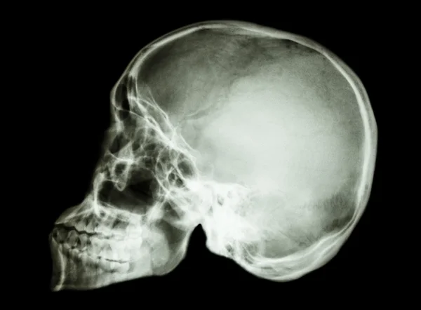 Crânio humano normal — Fotografia de Stock